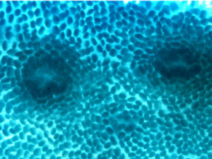 Bowel cancer cell. Cancer Research UK London Research Institute Experimental Histopathology Unit.