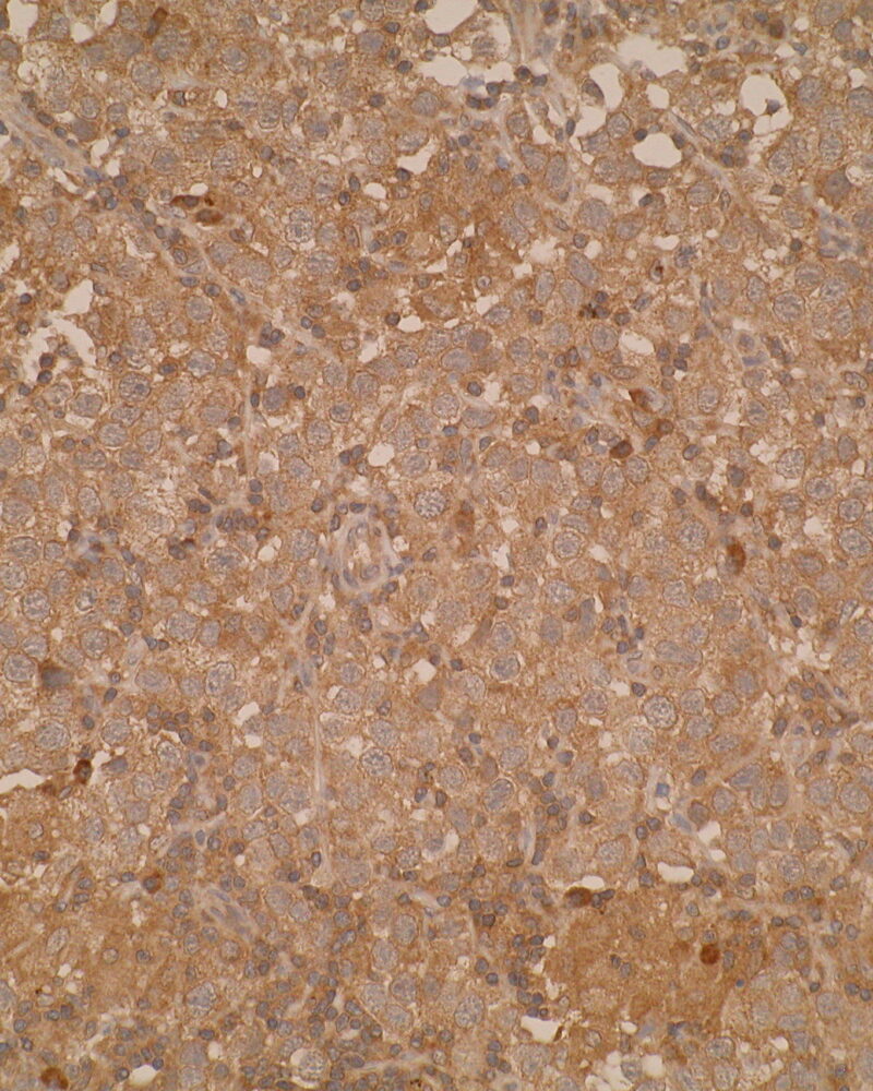Immunohistochemistry was performed on formalin-fixed; paraffin-embedded human testis seminoma tissue sections using anti-PDL2 (soluble form) [Z64P2D3*H4]. Cytoplasmic staining was observed.