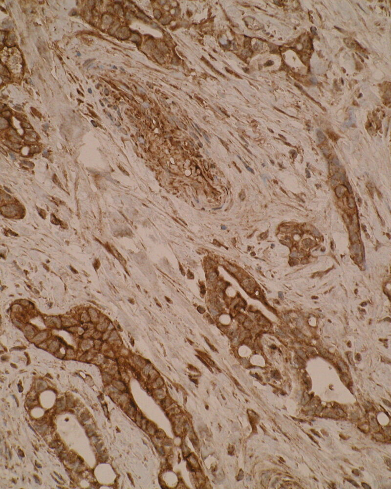 Immunohistochemistry was performed on formalin-fixed paraffin-embedded pancreatic adenocarcinoma tissue using anti-SLA2 [Z30P1F12*F4]. Cytoplasmic staining was observed.