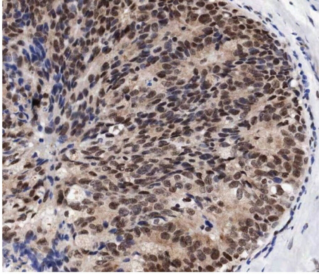 Human breast cancer stained with an antibody to Pax-2. Image: Provided by Jason Carroll at the CRI.