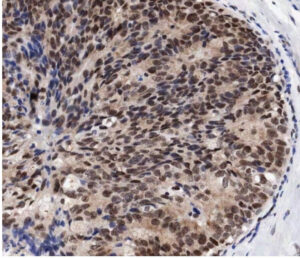Human breast cancer stained with an antibody to Pax-2. Image: Provided by Jason Carroll at the CRI.