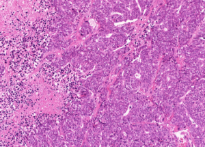 Representative example of haematoxylin and eosin staining of CRUK0606 T1-R1 TRACERx lung cancer PDX model at early P0 passage.