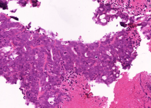 Representative example of haematoxylin and eosin staining of CRUK0606 T1-R5 TRACERx lung cancer PDX model at early P0 passage.