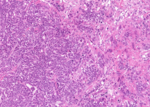 Representative example of haematoxylin and eosin staining of CRUK0606 T1-R6 TRACERx lung cancer PDX model at early P0 passage.