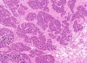Representative example of haematoxylin and eosin staining of CRUK0606 T1-R8 TRACERx lung cancer PDX model at early P0 passage.