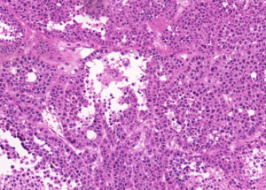 Representative example of haematoxylin and eosin staining of CRUK0640 T1-R3 TRACERx lung cancer PDX model at early P0 passage.