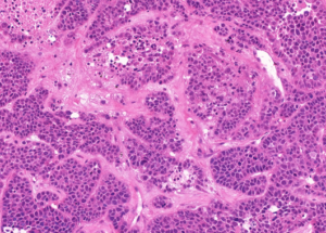 Representative example of haematoxylin and eosin staining of CRUK0640 T1-R5 TRACERx lung cancer PDX model at early P0 passage.