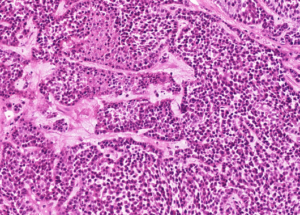 Representative example of haematoxylin and eosin staining of CRUK0640 T1-R7 TRACERx lung cancer PDX model at early P0 passage.