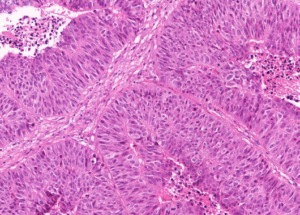 Representative example of haematoxylin and eosin staining of CRUK0718 T1-R7 TRACERx lung cancer PDX model at early P0 passage.