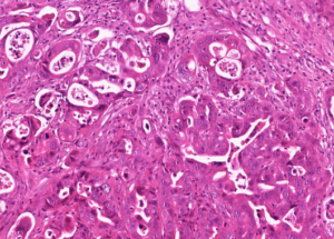 Representative example of haematoxylin and eosin staining of CRUK0733 T1-R3 TRACERx lung cancer PDX model at early P0 passage.
