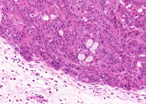 Representative example of haematoxylin and eosin staining of CRUK0748 T1-R3 TRACERx lung cancer PDX model at early P0 passage.