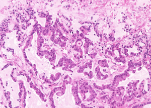 Representative example of haematoxylin and eosin staining of CRUK0748 T1-R8 TRACERx lung cancer PDX model at early P0 passage.