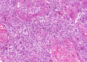 Representative example of haematoxylin and eosin staining of CRUK0772 T1-R1 TRACERx lung cancer PDX model at early P0 passage.