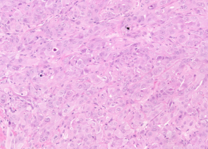 Representative example of haematoxylin and eosin staining of CRUK0816 T1-R2 TRACERx lung cancer PDX model at early P0 passage.