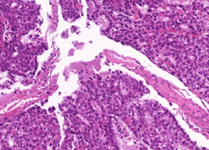 Representative example of haematoxylin and eosin staining of CRUK0817 T1-IR TRACERx lung cancer PDX model at early P0 passage.