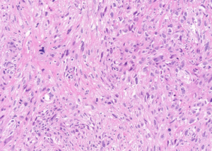 Representative example of haematoxylin and eosin staining of CRUK0885 T1-R3 TRACERx lung cancer PDX model at early P0 passage.