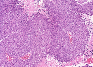 Representative example of haematoxylin and eosin staining of CRUK0935 T1-R6 TRACERx lung cancer PDX model at early P0 passage.