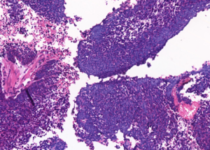 Representative example of haematoxylin and eosin staining of CRUK0935 T1-R7 TRACERx lung cancer PDX model at early P0 passage.