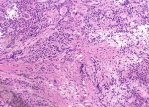 Representative example of haematoxylin and eosin staining of CRUK0935 T1-R8 TRACERx lung cancer PDX model at early P0 passage.