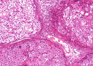 Representative example of haematoxylin and eosin staining of CRUK0949 T1-R3 TRACERx lung cancer PDX model at early P0 passage.