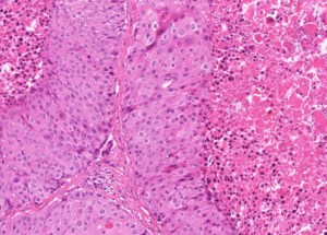 Representative example of haematoxylin and eosin staining of CRUK0949 T1-R4 TRACERx lung cancer PDX model at early P0 passage.