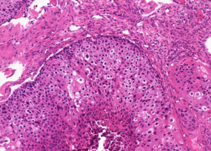 Representative example of haematoxylin and eosin staining of CRUK0949 T1-R5 TRACERx lung cancer PDX model at early P0 passage.