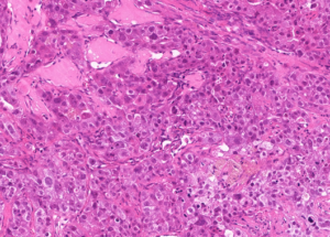 Representative example of haematoxylin and eosin staining of CRUK0995 T1-R1 TRACERx lung cancer PDX model at early P0 passage.
