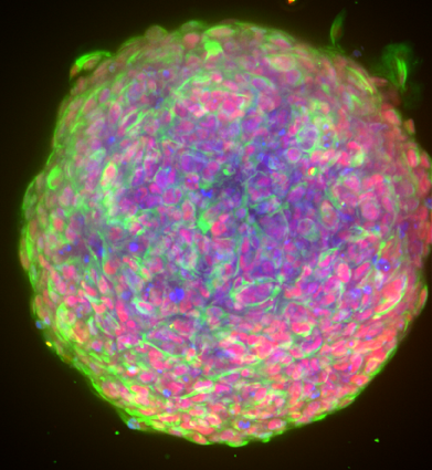 GCGR-E13 GBM stem cell line cultured as a 3D spheroid labelled with DNA (blue); SOX2 (red); Vimentin (green).