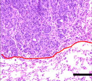Hematoxylin and eosin stain showing orthotopic lung tumor formation by the KrasG12D.Smad4+/– (X577) murine lung cancer cell line