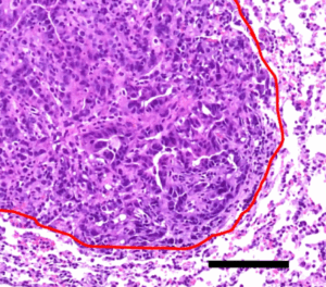 Hematoxylin and eosin stain showing orthotopic lung tumor formation by the KrasG12D.Map3k7−/−.GFP+ (E889) murine lung cancer cell line