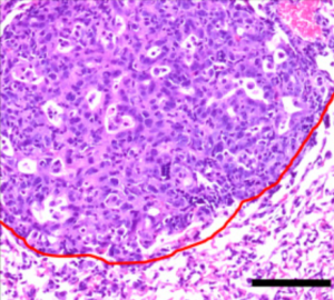 Hematoxylin and eosin stain showing orthotopic lung tumor formation by the KrasG12D.Tgfbr2−/− (X911) murine lung cancer cell line