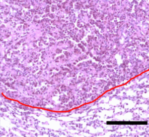 Hematoxylin and eosin stain showing orthotopic lung tumor formation by the EML4‑ALK mutant (Y143) murine lung cancer cell line