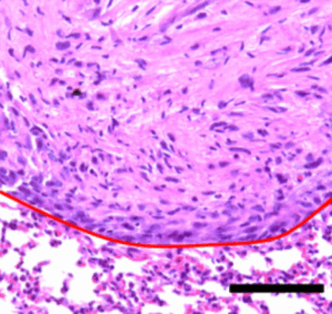 Hematoxylin and eosin stain showing orthotopic lung tumor formation by the Pik3ca+.p53+/− (Y856) murine lung cancer cell line