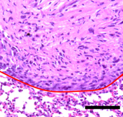 Hematoxylin and eosin stain showing orthotopic lung tumor formation by the Pik3ca+.p53+/− (Y856) murine lung cancer cell line