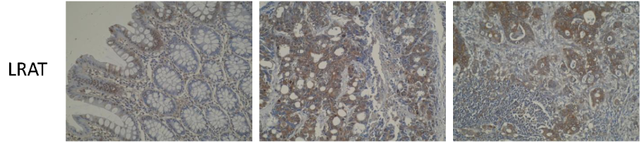 Figure 12. Photomicrographs of normal colonic mucosa (left), primary colorectal cancer (middle) and metastatic CRC (right), showing elevated cytoplasmic LRAT staining in primary and metastatic tissues (PMID: 24608339).
