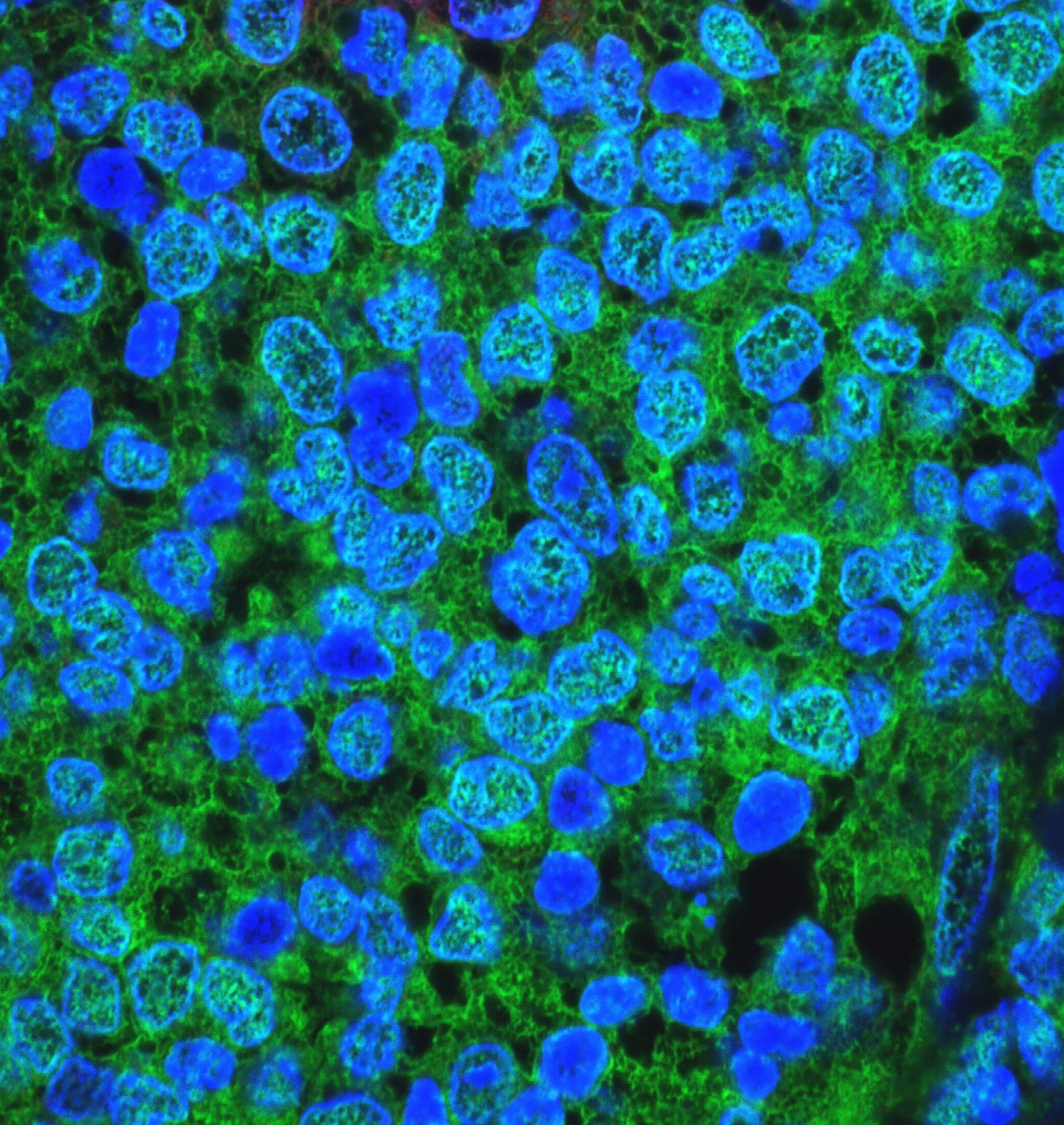 Breast cancer cells resisting treatment. Contributed by Saumya Samadhiya