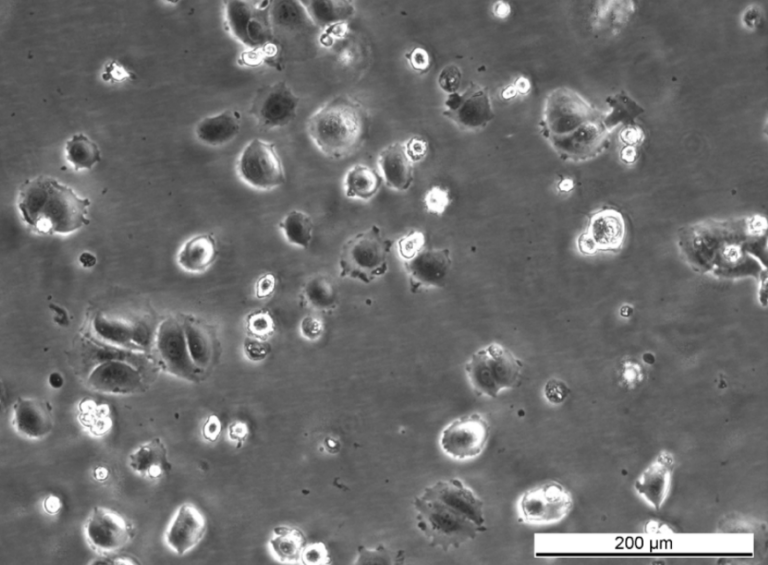 MCF7 164R-4 Cell Line. Early log phase. Image courtesy of the European Collection of Authenticated Cell Cultures (ECACC)
