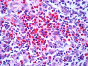 Image: Light micrograph of a section through a lymph node affected by Hodgkin’s lymphoma, a cancer of lymphoma white blood cells. Stock image.