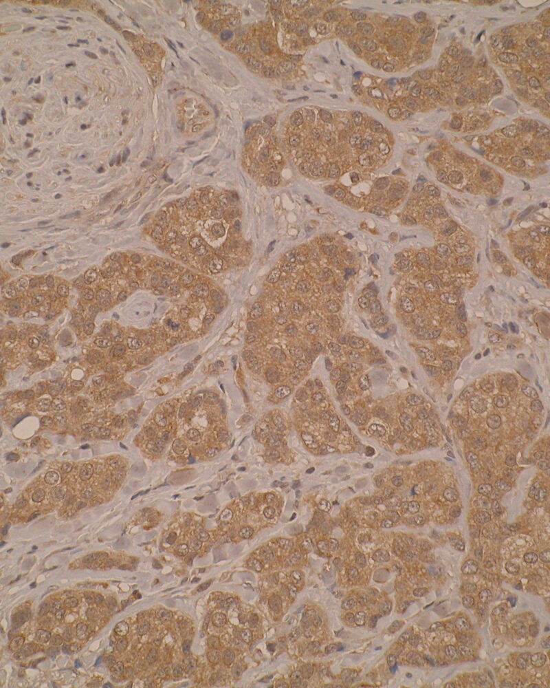 Immunohistochemistry was performed on formalin-fixed; paraffin-embedded human breast cancer tissue sections using Anti-FANCB [M38P3E10]. The antibody shows both nuclear and cytoplasmic staining but it is predominately cytoplasmic.