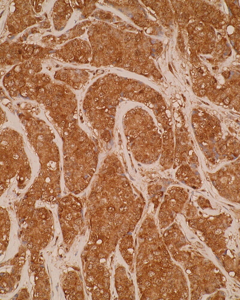 Immunohistochemistry was performed on formalin-fixed; paraffin-embedded human breast cancer sections using anti-CIDE A [V62P1E3*B10]. Positive cytoplasmic staining is shown.