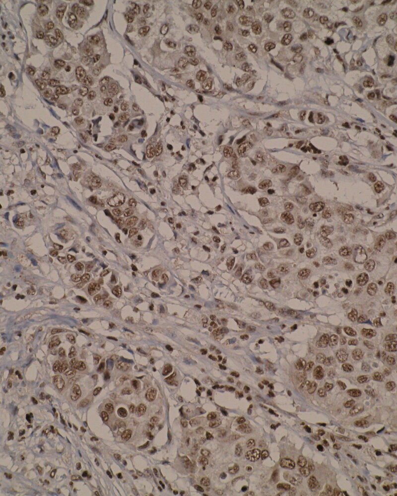 Immunohistochemistry was performed on formalin-fixed; paraffin-embedded breast cancer tissue sections using anti-TMEM2L [V98P4E1*B7] antibody. Strong cytoplasmic and nuclear staining were detected.